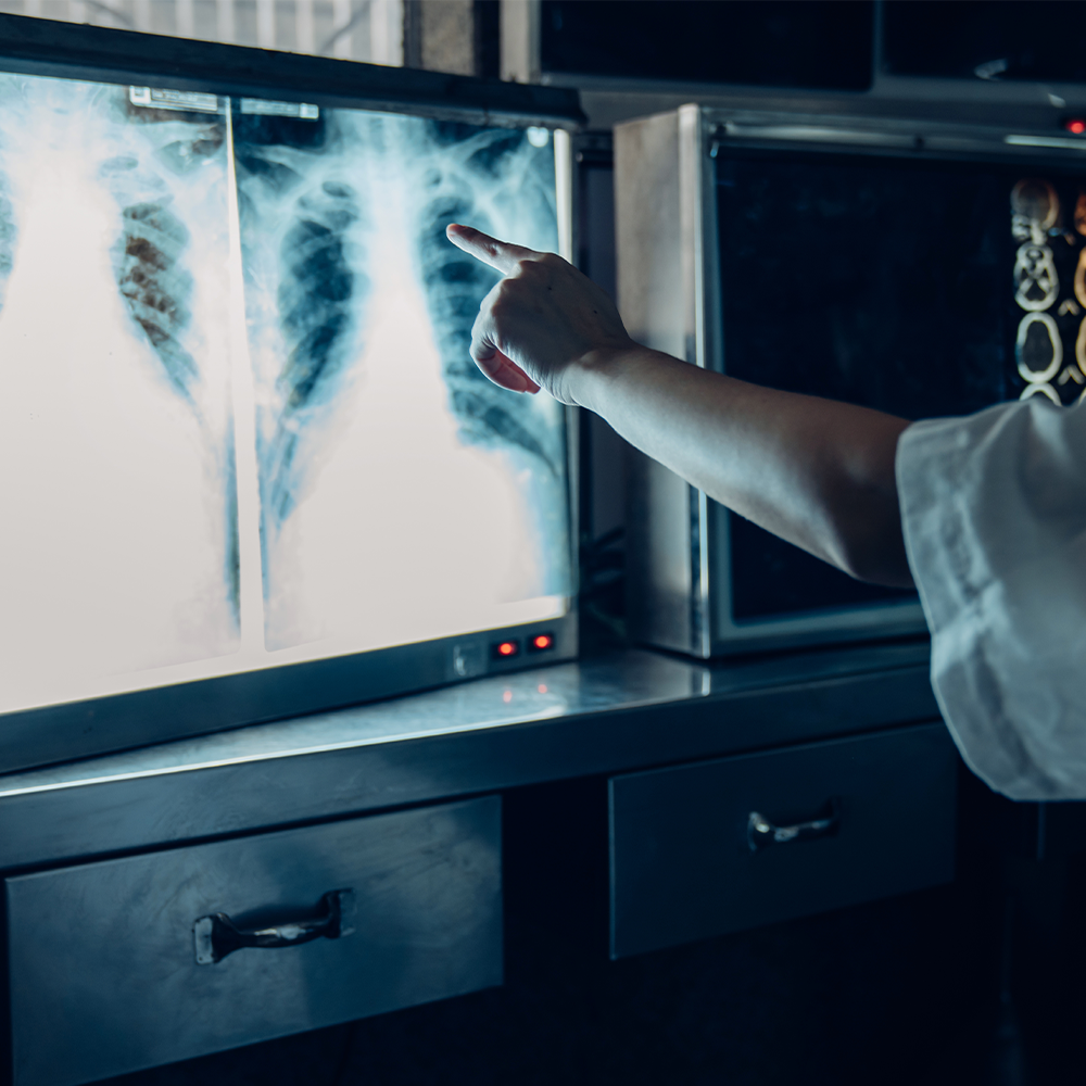 Doctor looking at a lung x-ray